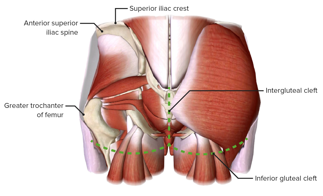 Gluteal Cleft image